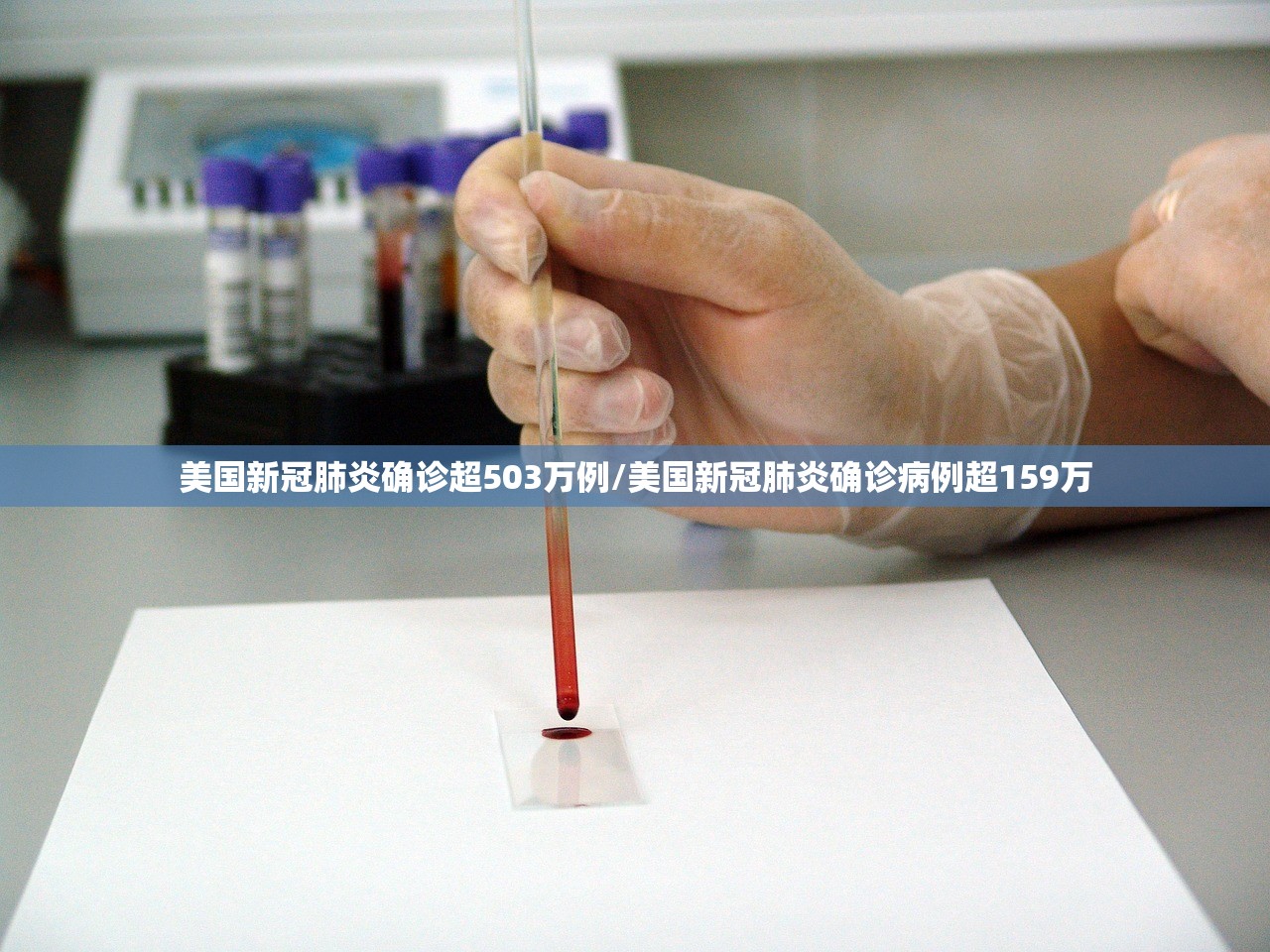 美国新冠肺炎确诊超503万例/美国新冠肺炎确诊病例超159万